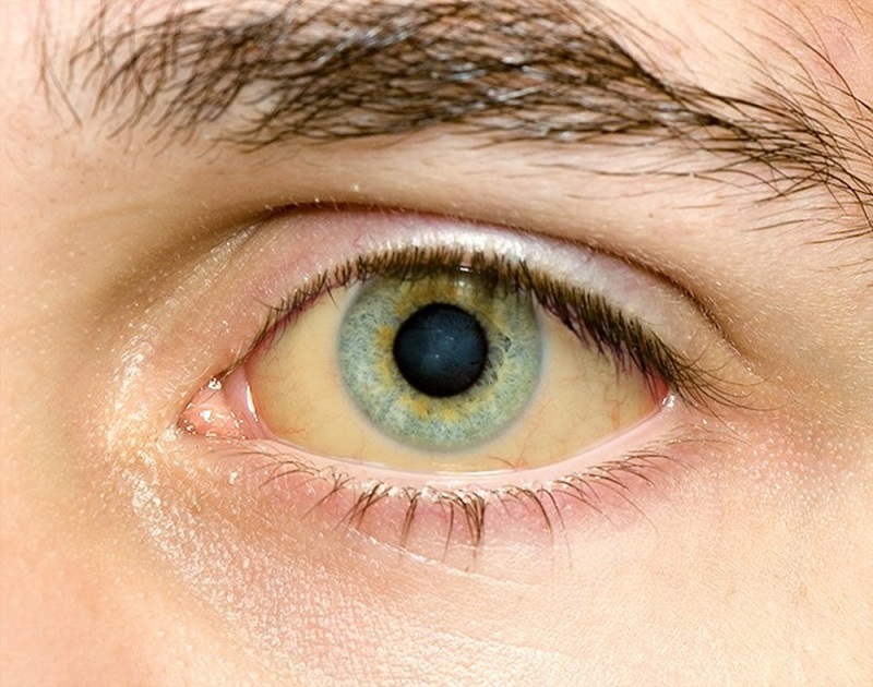 Hình ảnh vàng mắt ở người bệnh viêm gan B