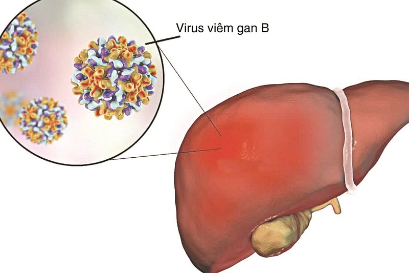 Hình ảnh lá gan bị viêm gan B