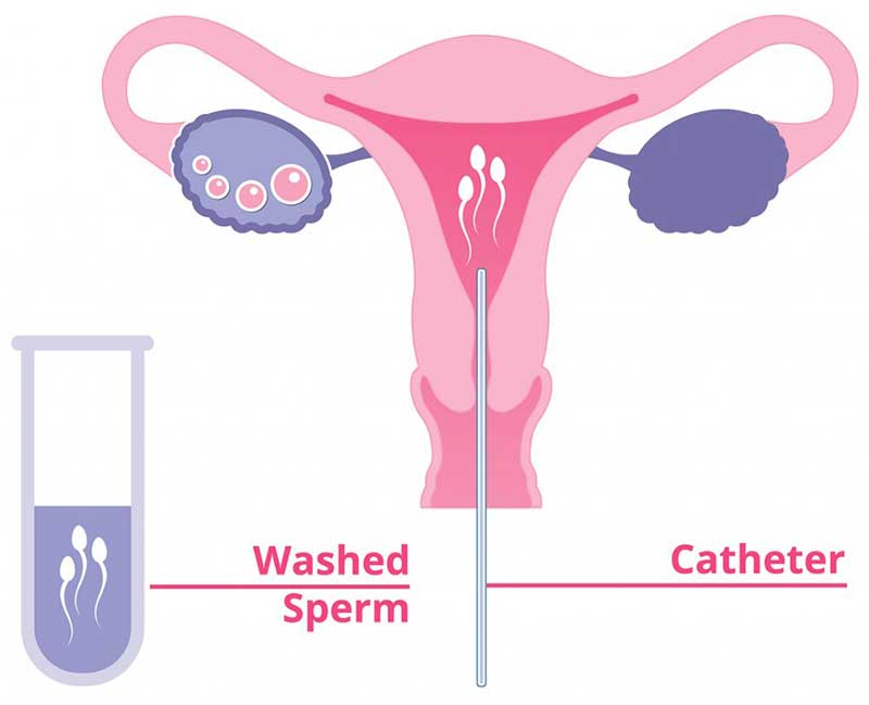 Ảnh minh họa cho quá trình bơm tinh trùng vào buồng tử cung (IUI) 