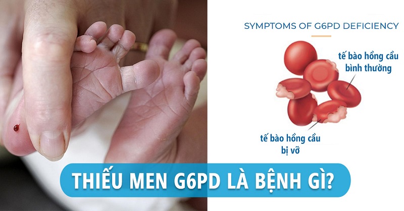 Men G6PD đóng vai trò quan trọng trong việc bảo vệ hồng cầu trước sự tấn công của các chất oxy hóa