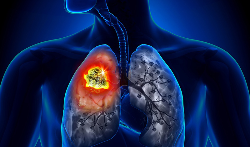 Di chứng của ung thư phổi có thể gây tràn dịch phổi