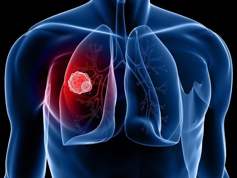 áp xe phổi hình thành gây ảnh hưởng tới chức năng của phổi