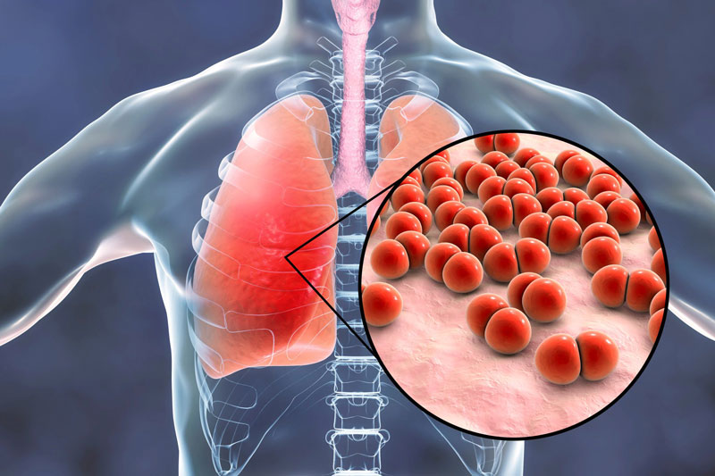 Phế cầu khuẩn gây ra một số bệnh về hô hấp