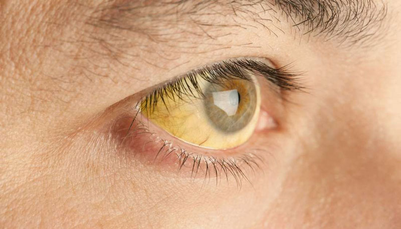 Vàng mắt là biểu hiện thường gặp ở người bệnh gan