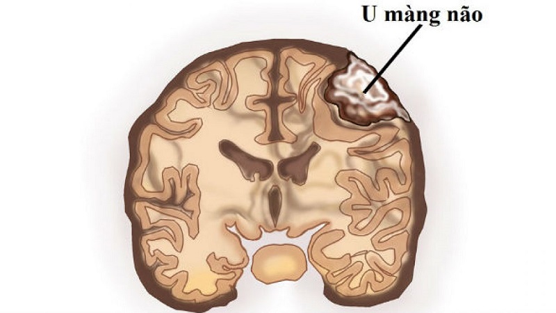 Hình ảnh minh họa u màng não. 