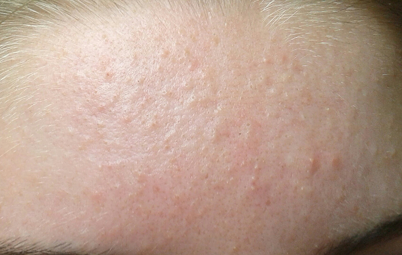 Tình trạng mụn ẩn với các nốt li ti trên bề mặt da