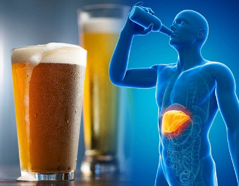 Rượu bia là một trong các tác nhân gây vôi hóa gan