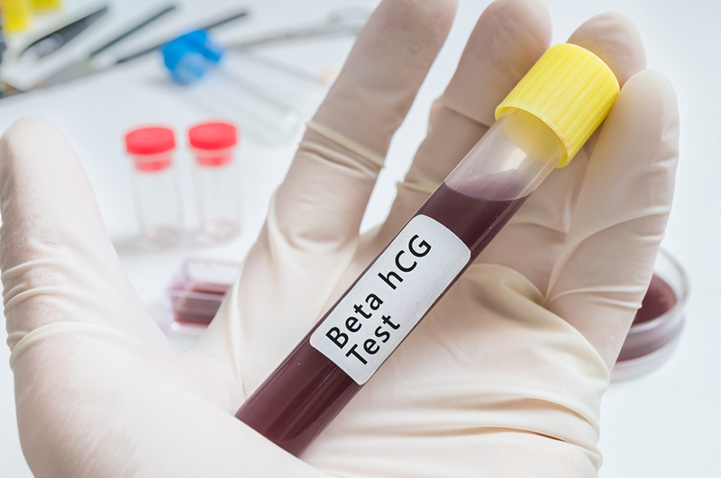 Bác sĩ sẽ tiến hành xét nghiệm Beta-hCG thông qua mẫu máu