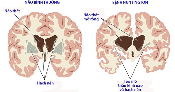 Bệnh múa giật Huntington là một bệnh có tinh chất di truyền, nguyên nhân là do sự thoái hóa của các tế bào thần kinh trong não bộ gây ra