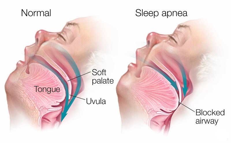 Hội chứng ngưng thở khi ngủ hay còn được biết đến là một loại rối loạn giấc ngủ