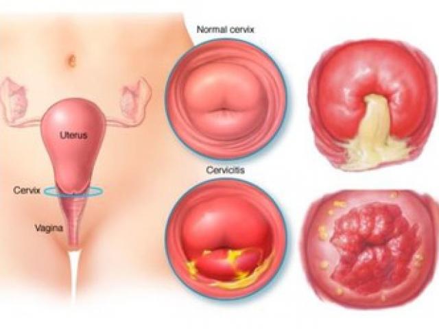 Sarcoma tử cung phát sinh từ cơ tử cung hoặc các yếu tố mô liên kết của nội mạc tử cung
