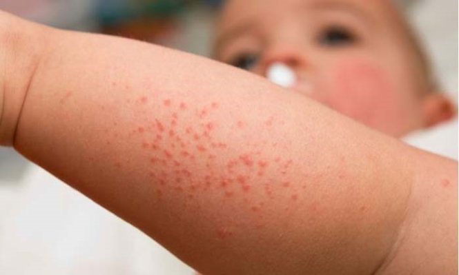 Sởi là một bệnh do vi-rút sởi gây ra, rất dễ lây, đặc trưng bởi sốt, phát ban, ho, sổ mũi và viêm kết mạc
