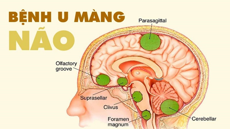Các khối u màng não lành tính thường xuất hiện ở vùng vòm não