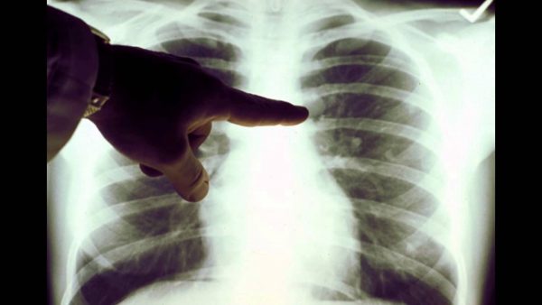 U lành tính ở phổi thường là những khối u phát triển chậm, không có dấu hiệu xâm lấn sang những tổ chức khác