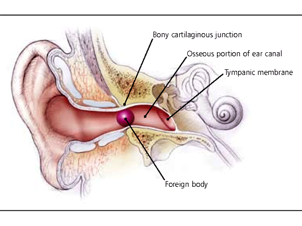 Có nhiều kỹ thuật lấy dị vật trong tai