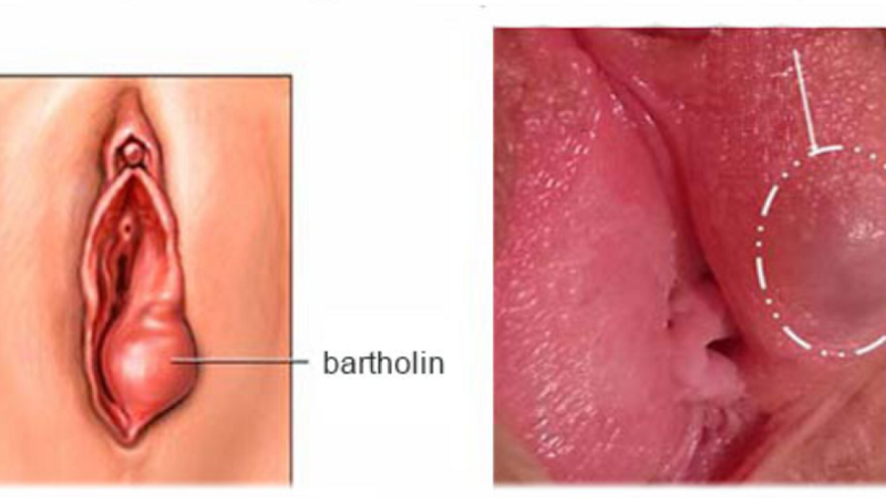 Nang tuyến Bartholin cần được thăm khám và điều trị từ sớm