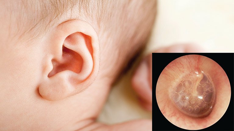 VTGTD kéo dài nếu không được điều trị đúng sẽ gây các di chứng nặng nề về tai giữa và hình thành ngôn ngữ, nhất là ở trẻ nhỏ < 2 tuổi