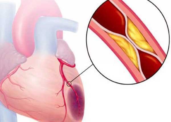 Sinh lý bệnh trong hội chứng mạch vành cấp không có ST chênh lên  chính là do sự mất ổn định của mảng vữa xơ động mạch vành