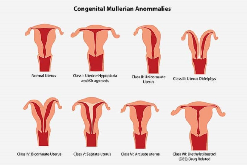 Hình ảnh mô tả các dị dạng tử cung bẩm sinh