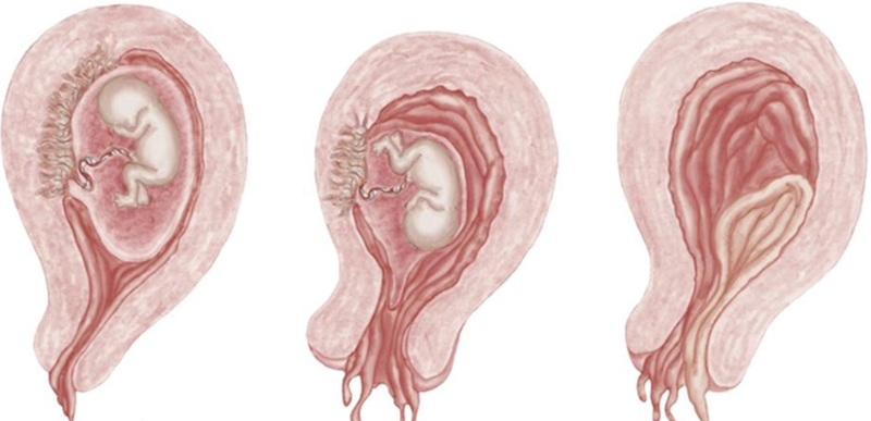 Hiện tượng mà thai bị đẩy ra ngoài buồng tử cung trước 20 tuần tuổi thai thì được gọi là sảy thai