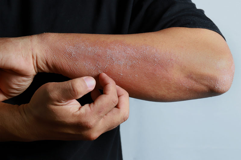 Bạn không nên gãi vào vùng da đang bị tổn thương