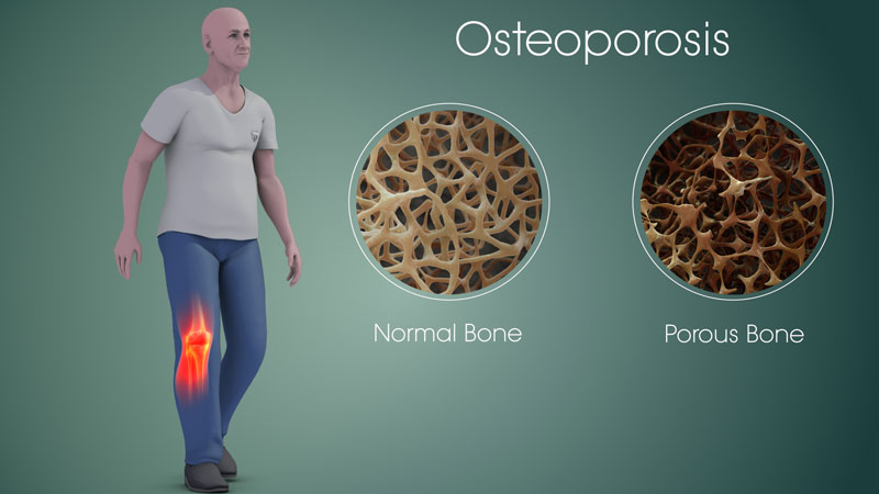 Loãng xương là một bệnh lý khá phổ biến