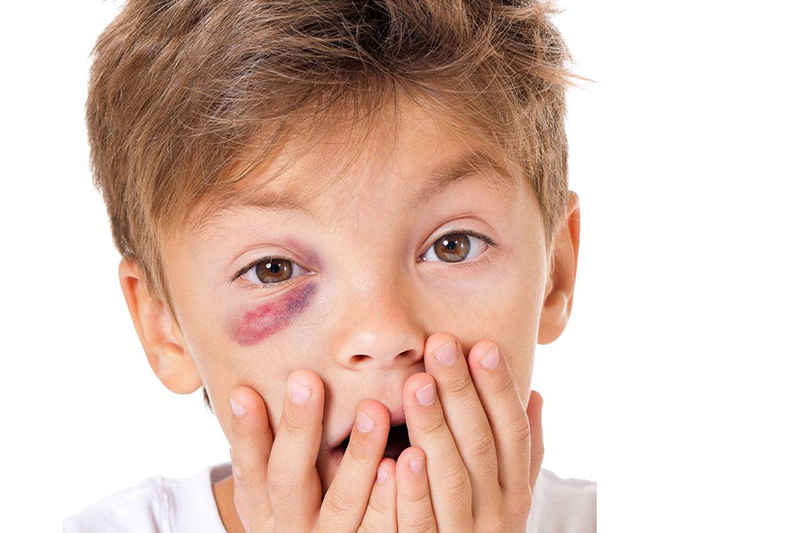 Những va chạm mạnh khiến vùng mắt bị chấn thương là nguyên nhân dẫn đến viễn thị ở trẻ nhỏ